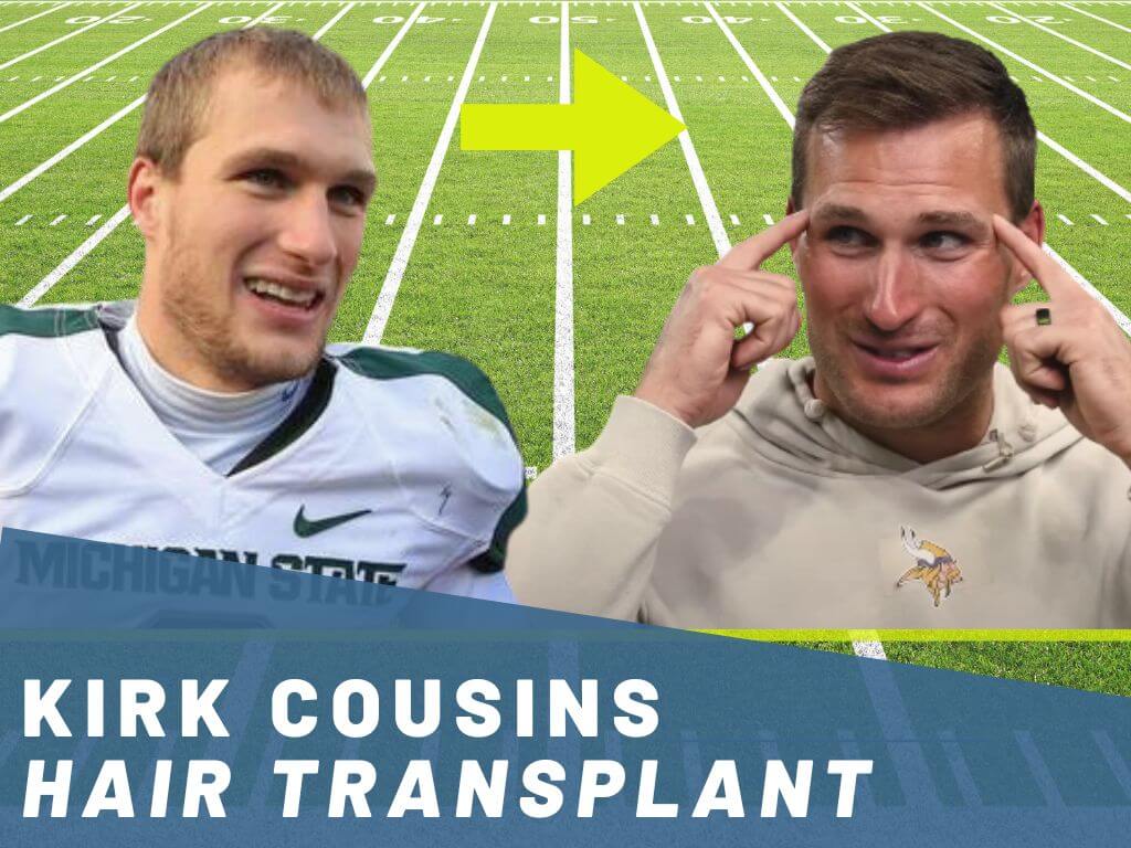 kirk cousins - hair transplant analysis banner