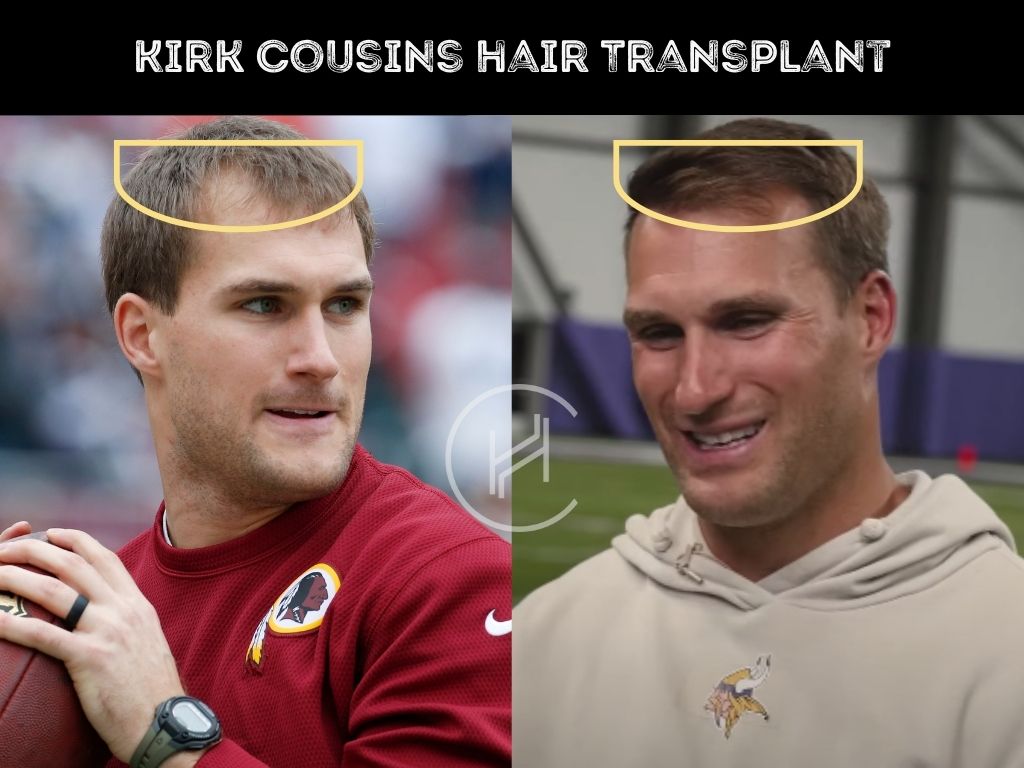 kirk cousins - hair transplant before after result