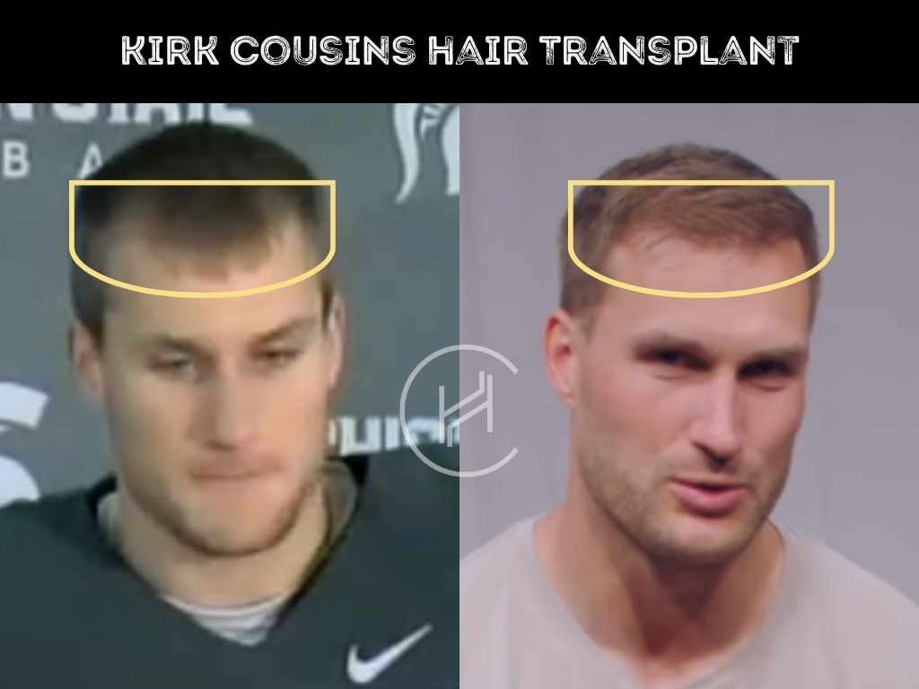 kirk cousins hair transplant before after