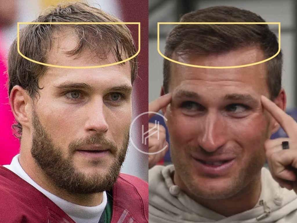 kirk cousins - hair transplant before and after result