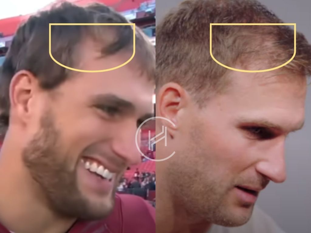 kirk cousins hair transplant before and after temple area
