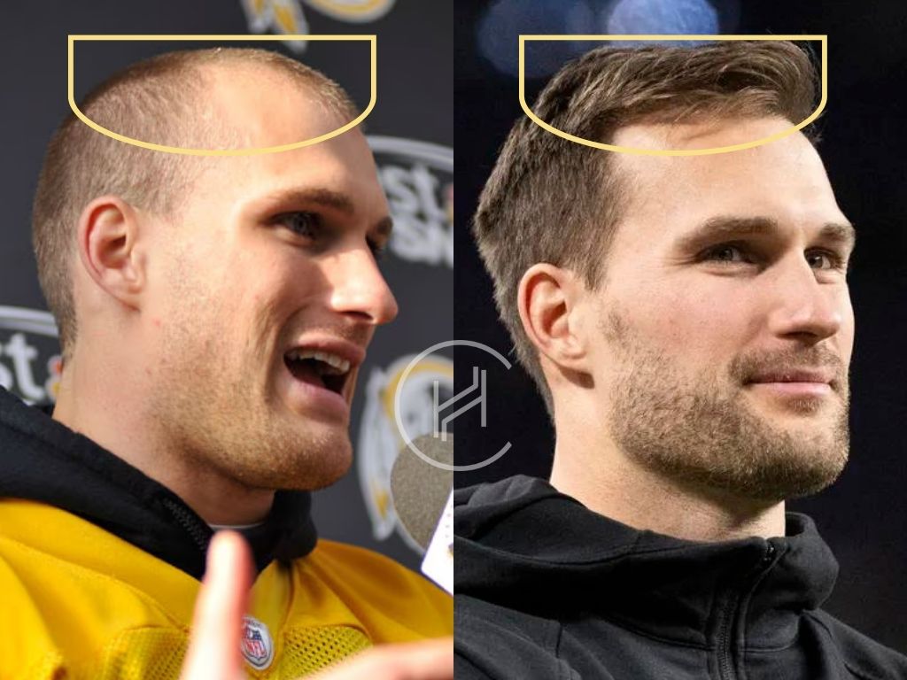 kirk cousins temple area before and after hair transplant surgery