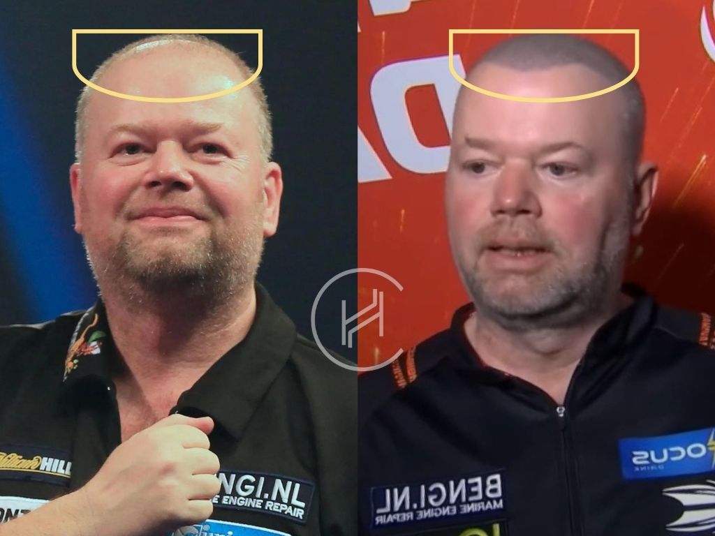 raymond van barneveld hair restoration tattoo before and after result