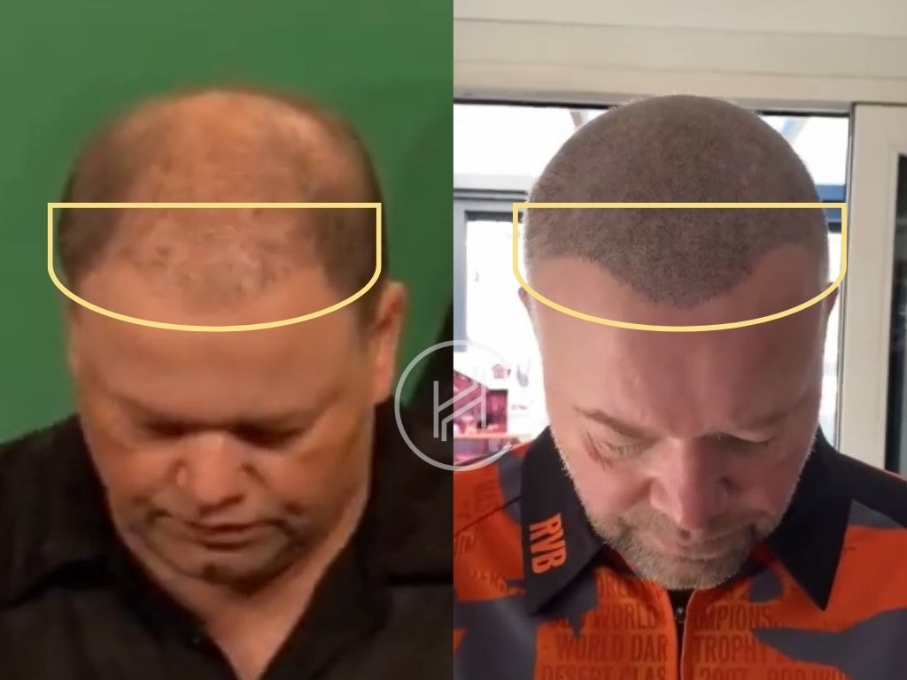 raymond van barneveld smp before and after