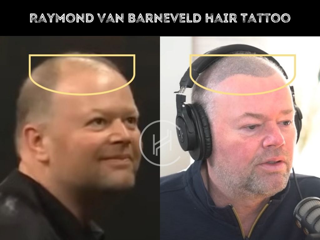raymond van barneveld scalp micropigmentation before after photo