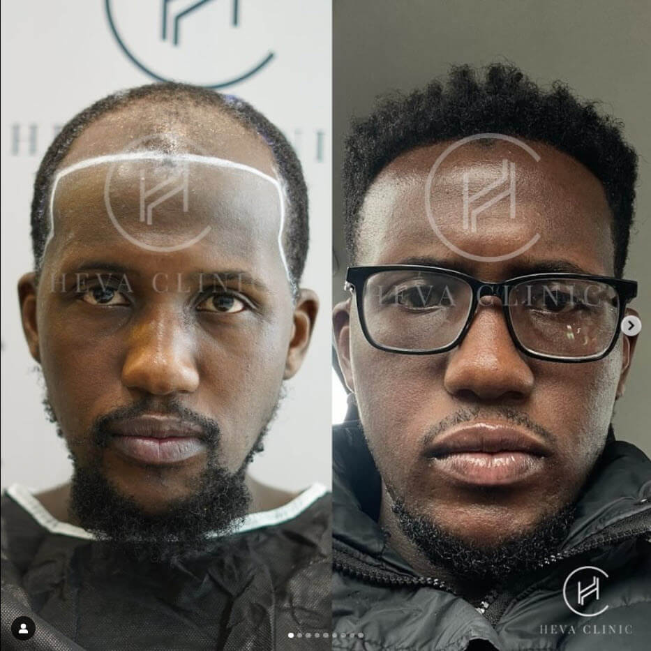 2800 grafts afro hair transplant result