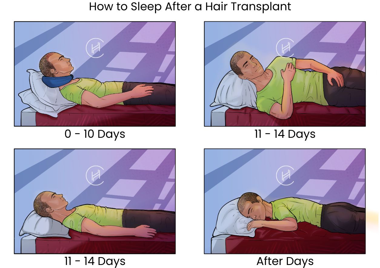 How to Sleep After a Hair Transplant Picture