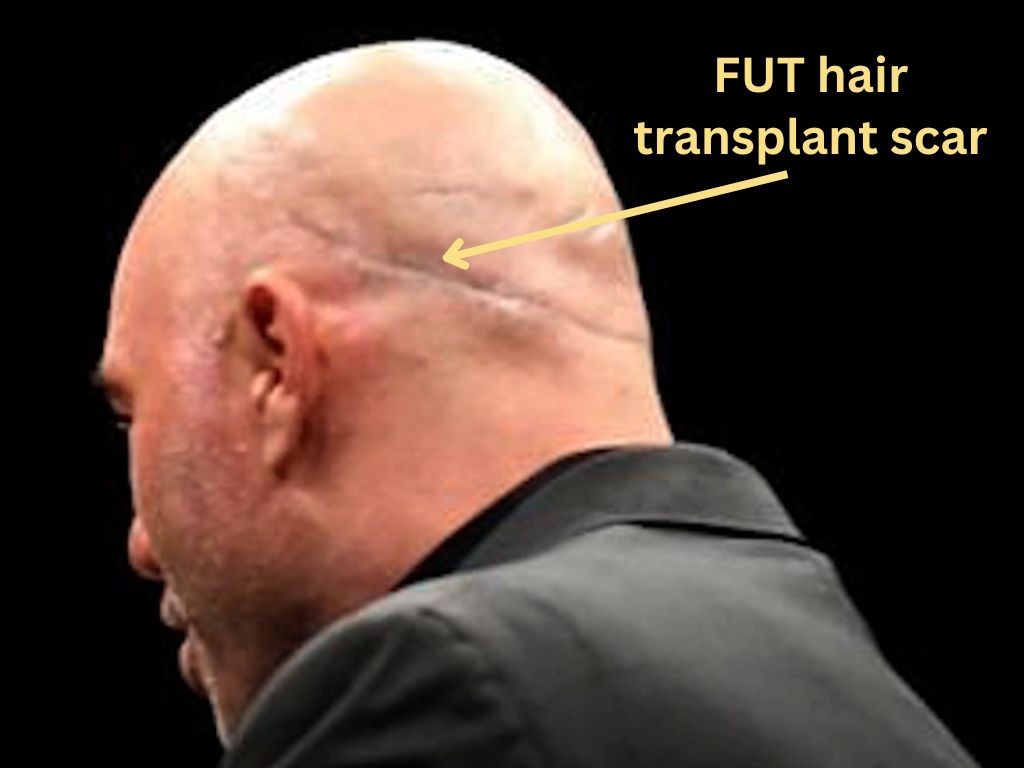 Joe rogan FUT hair transplant scar