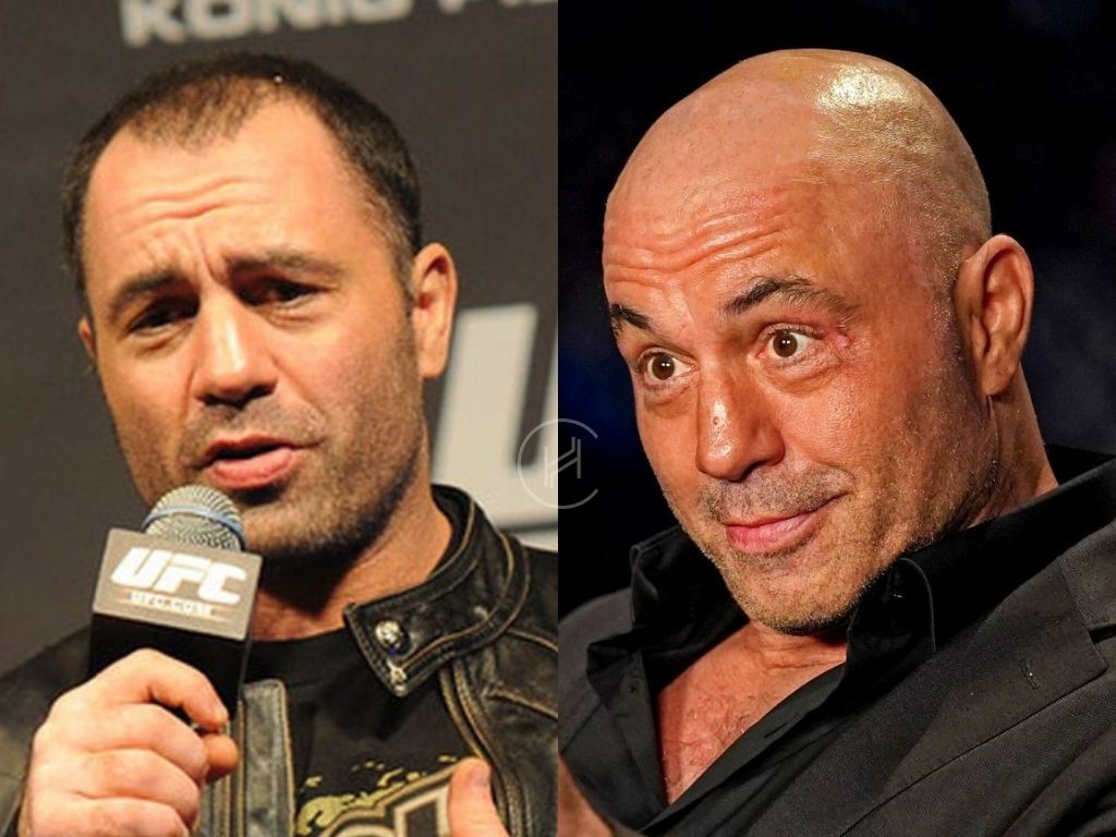 Joe Rogan Hair Transplant - Hair Loss & Technical Analysis