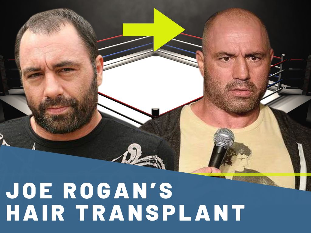 Joe rogan hair transplant and transformation analysis banner