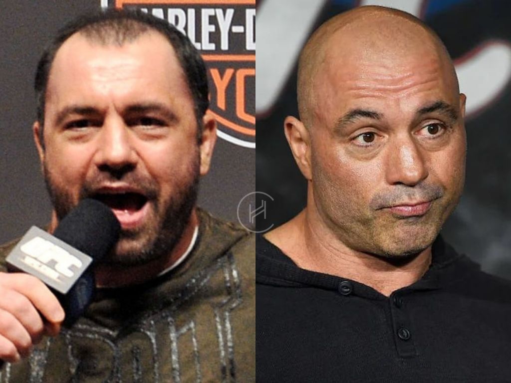 Joe rogan hair transplant before and after