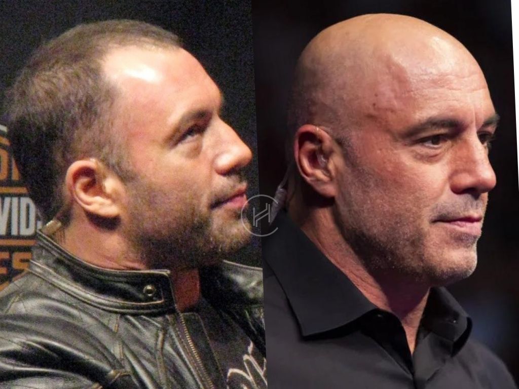 Joe rogan hair transplant result before and after
