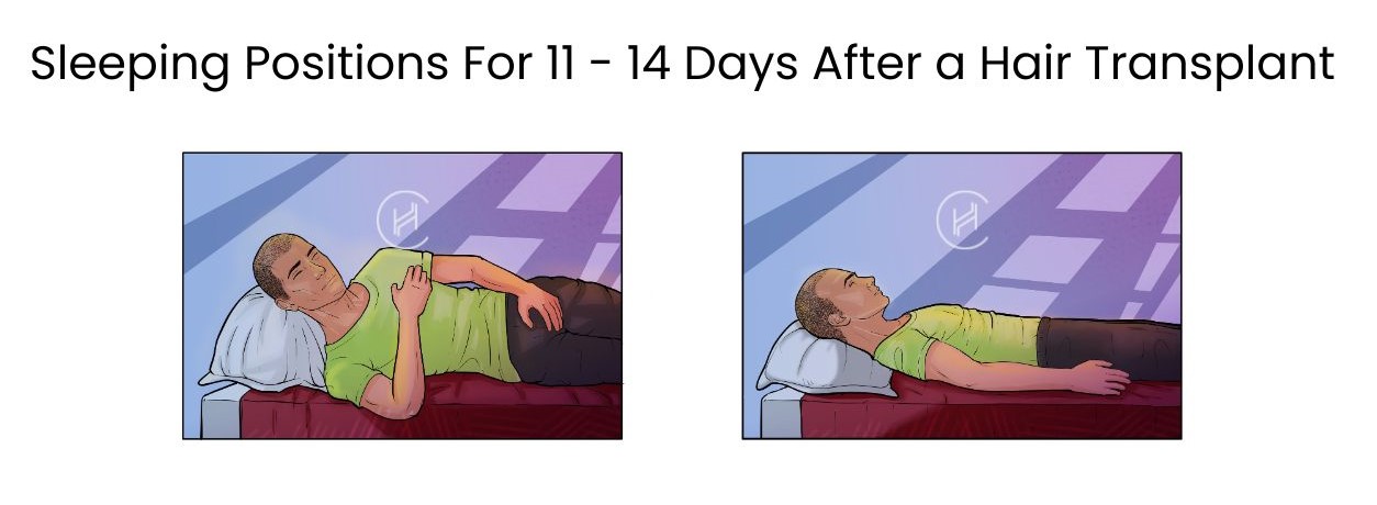 Sleeping Positions For 11 - 14 Days After a Hair Transplant