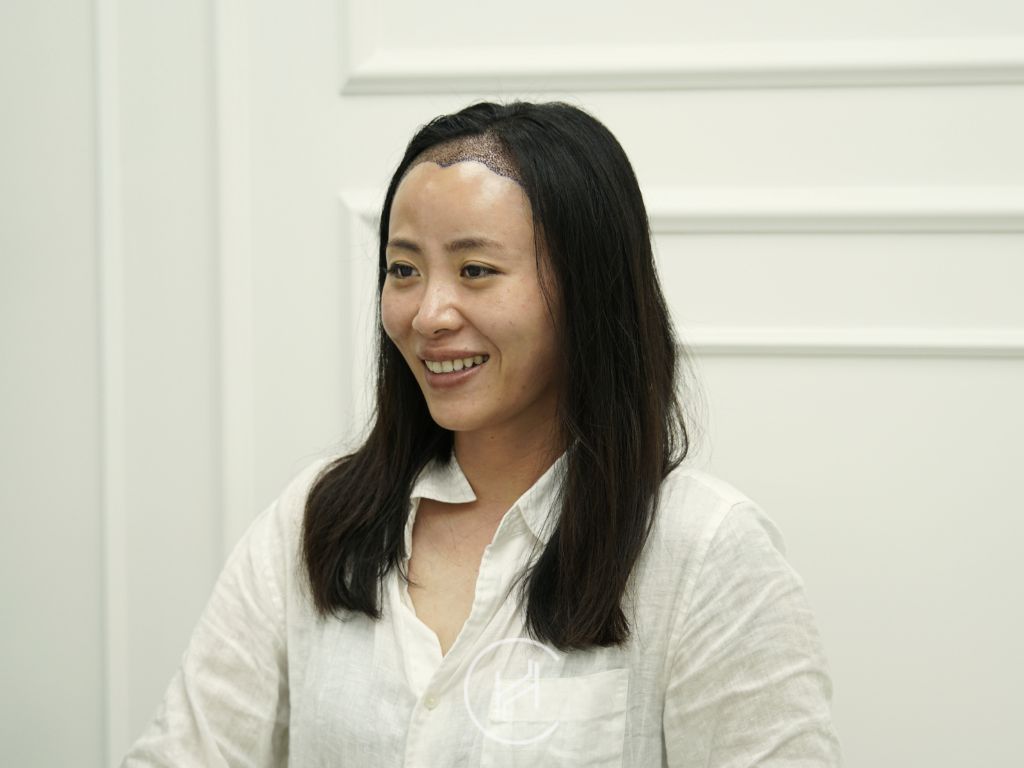 after hair transplant asian female after hair transplant asian female at heva clinic