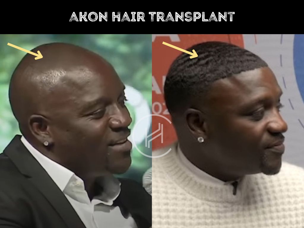 akon - hair transplant before after result