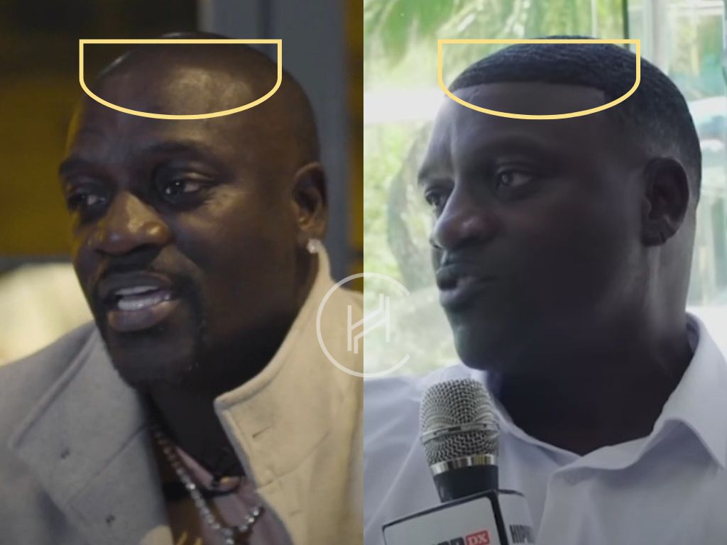 akon hair transplant before & after photo