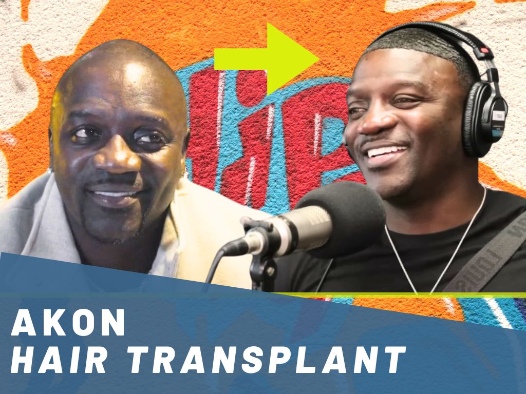 akon hair transplant before and after analysis banner