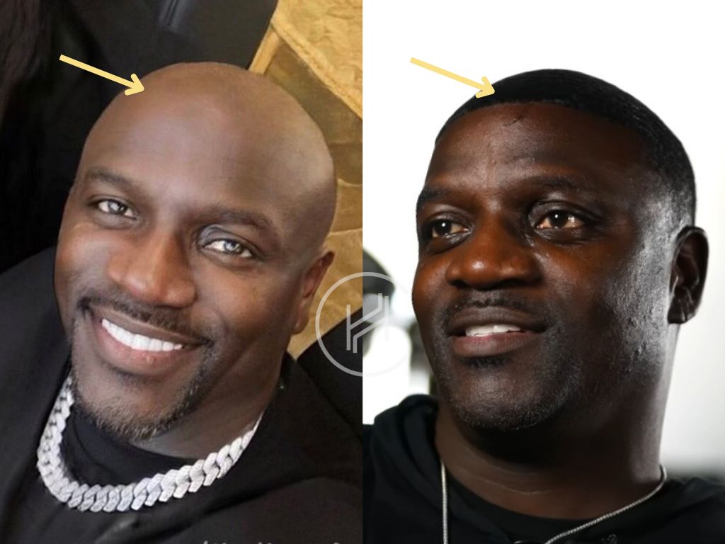 akon - hair transplant before and after result