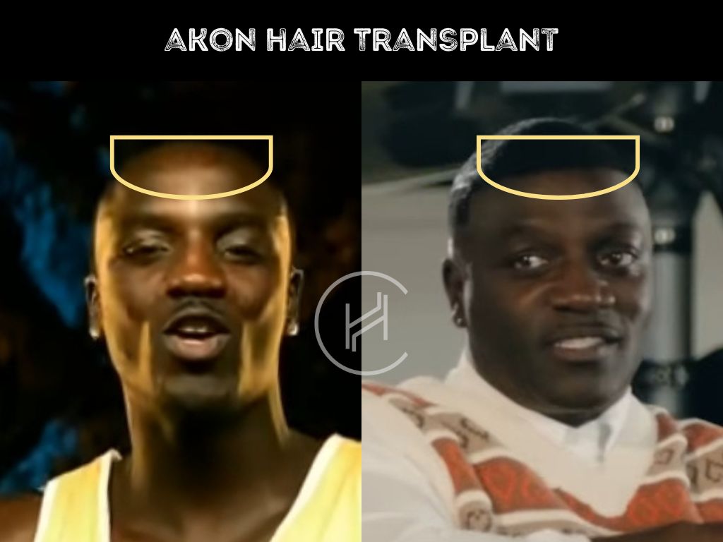 akon - hair transplant before and after