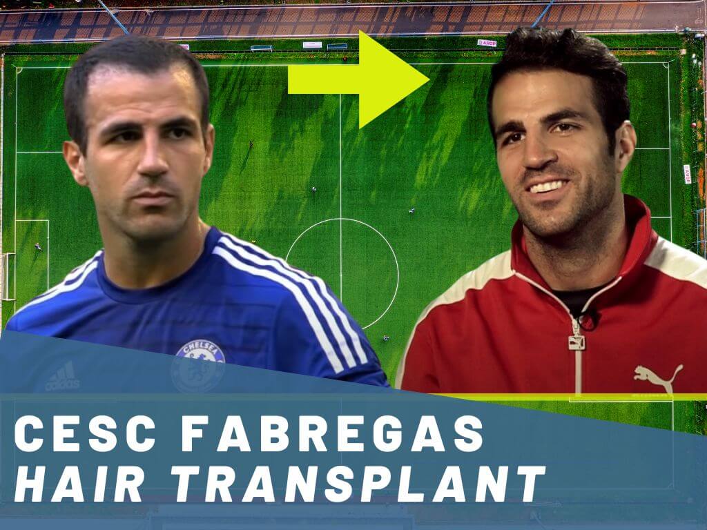 cesc fabregas hair transplant analysis