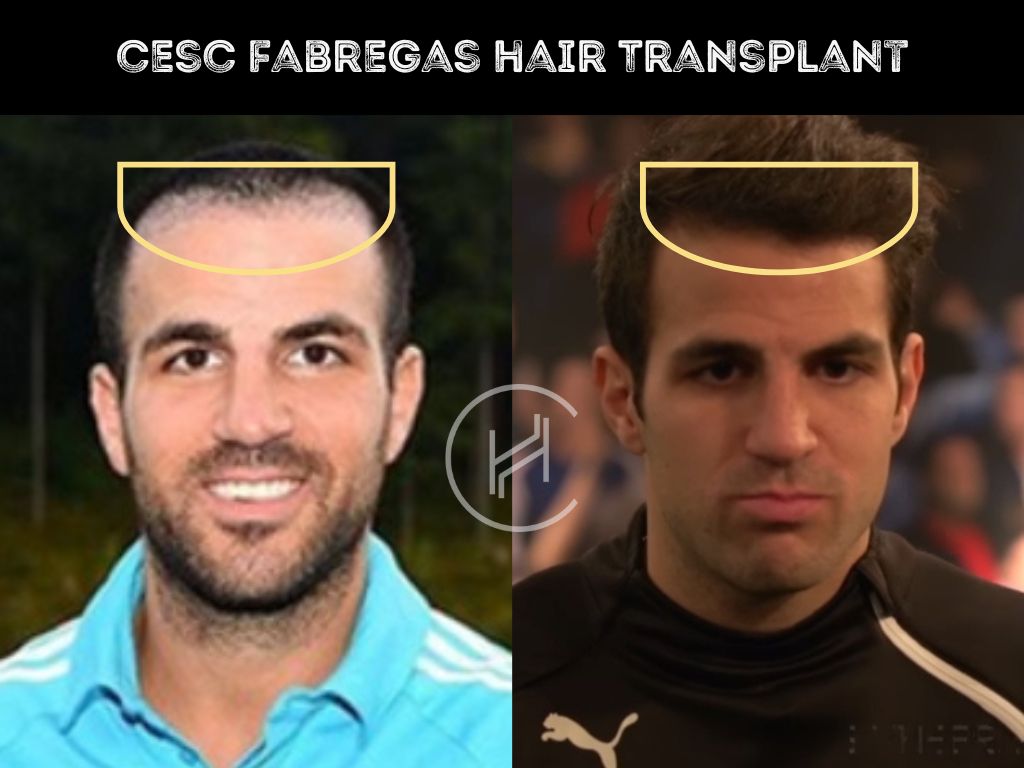 cesc fabregas hair transplant before after result
