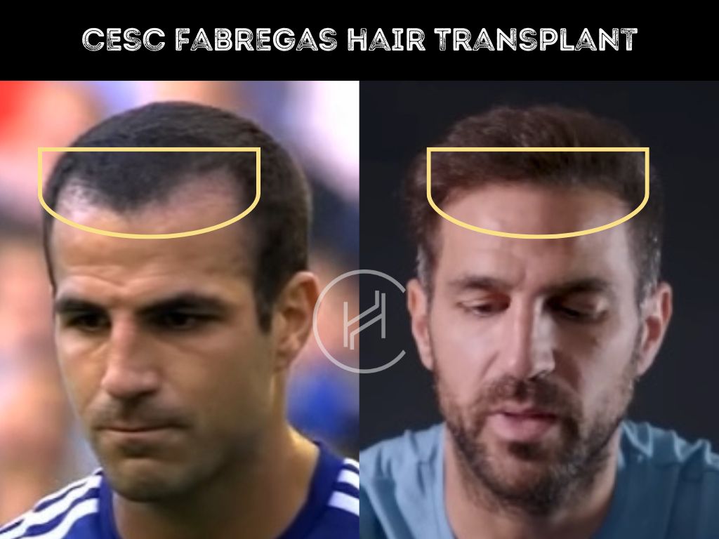 cesc-fabregas-hair-transplant-before-after