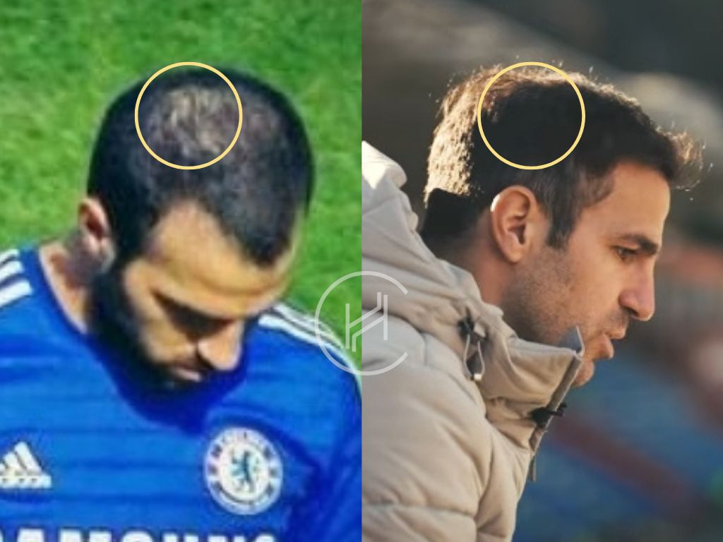 cesc fabregas -hair transplant before and after result