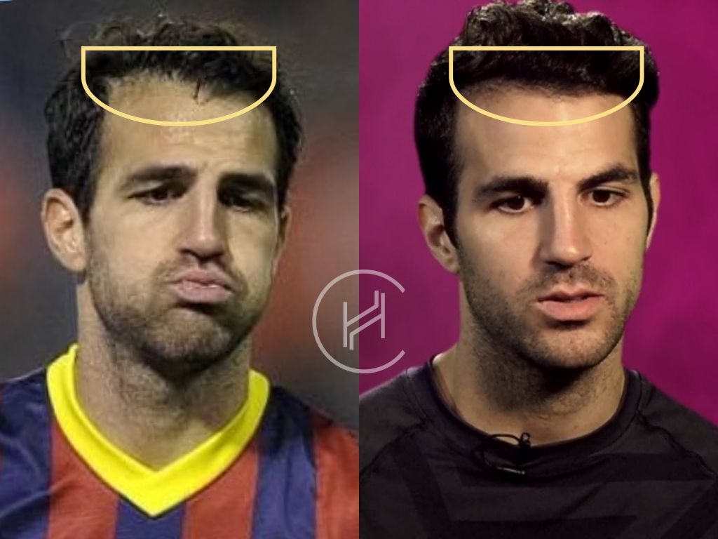 cesc fabregas hair transplant before and after