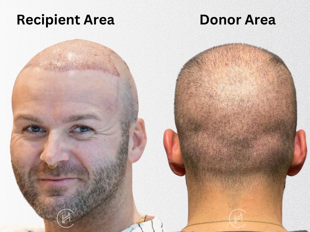donor and recipient areas in hair transplant