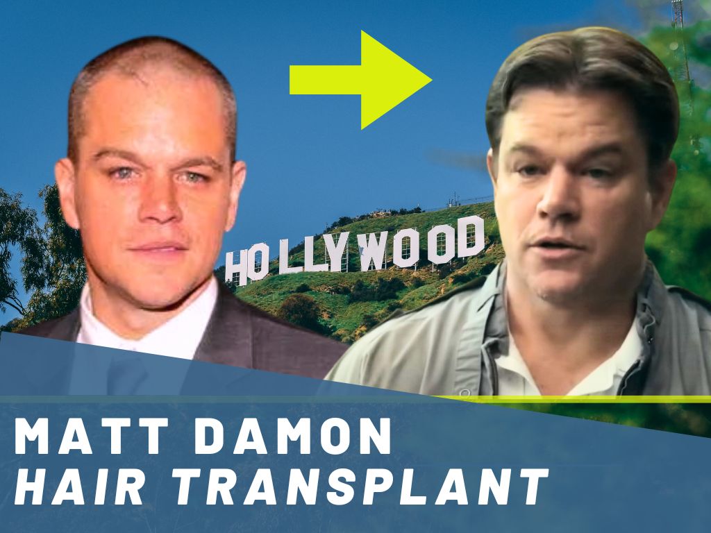 matt damon hair transplant banner