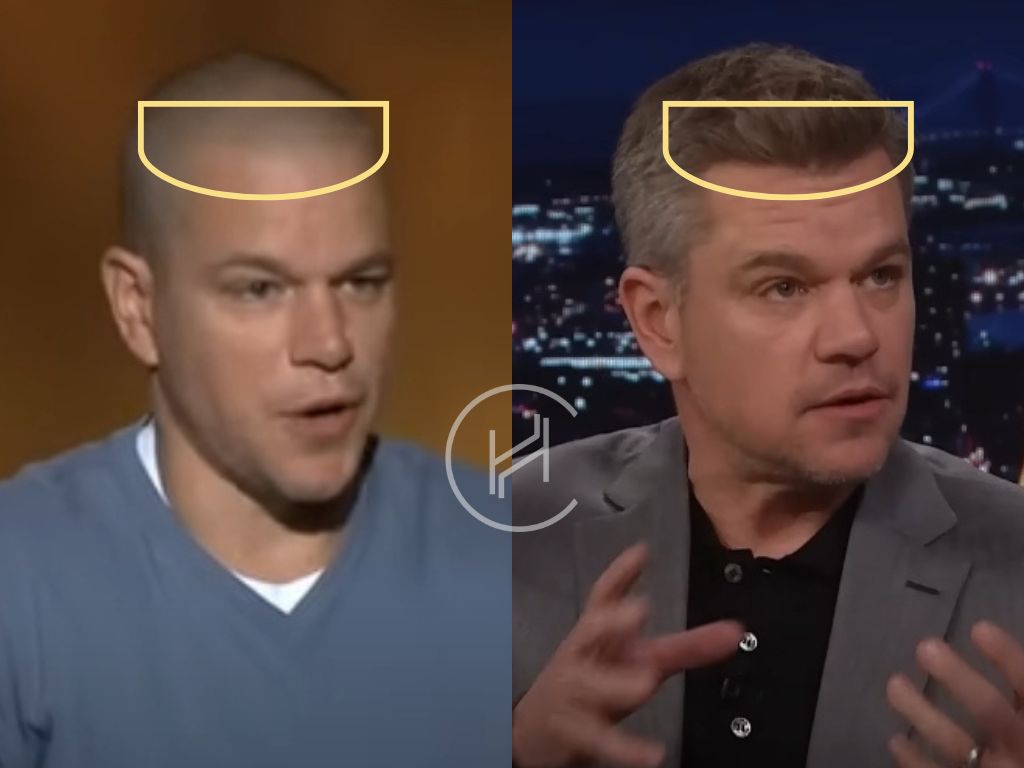 matt damon hair transplant before after result