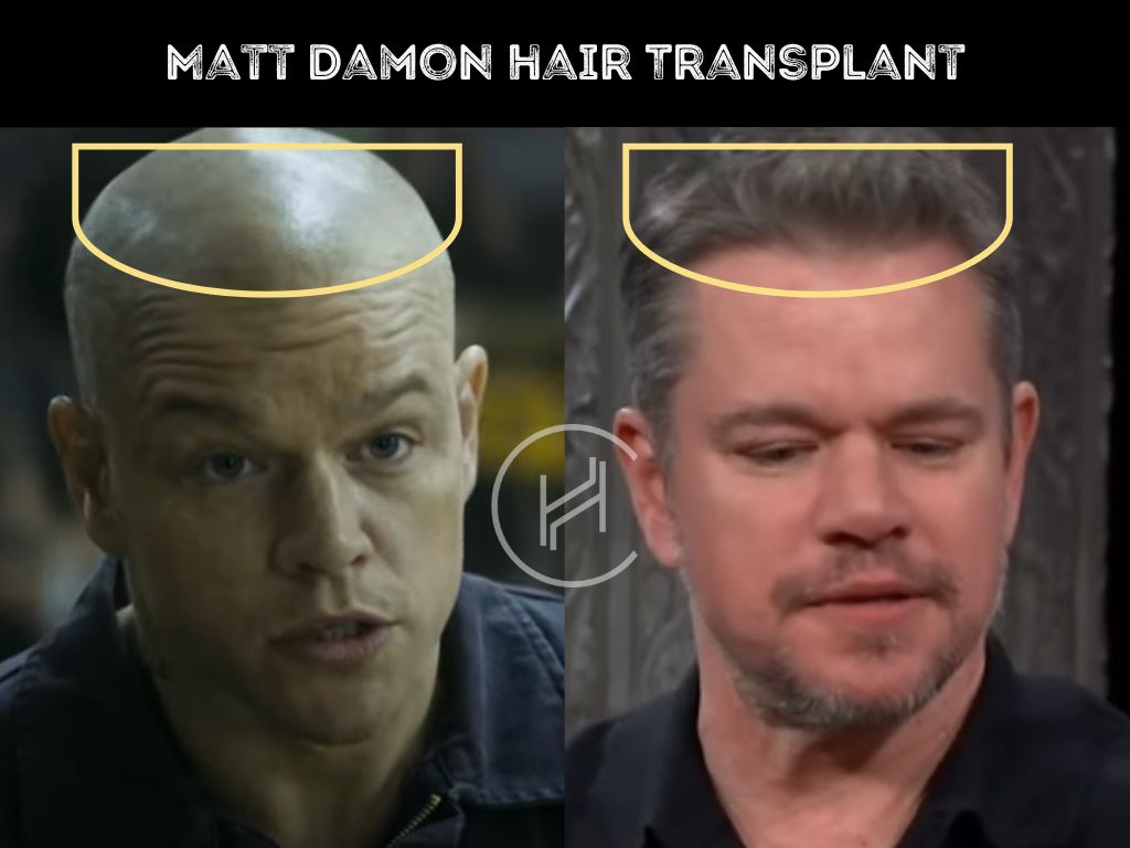 matt damon hair transplant before after