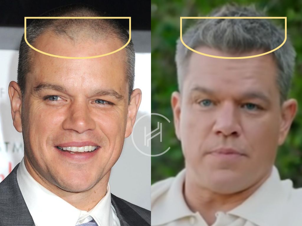 matt damon - hair transplant before and after result