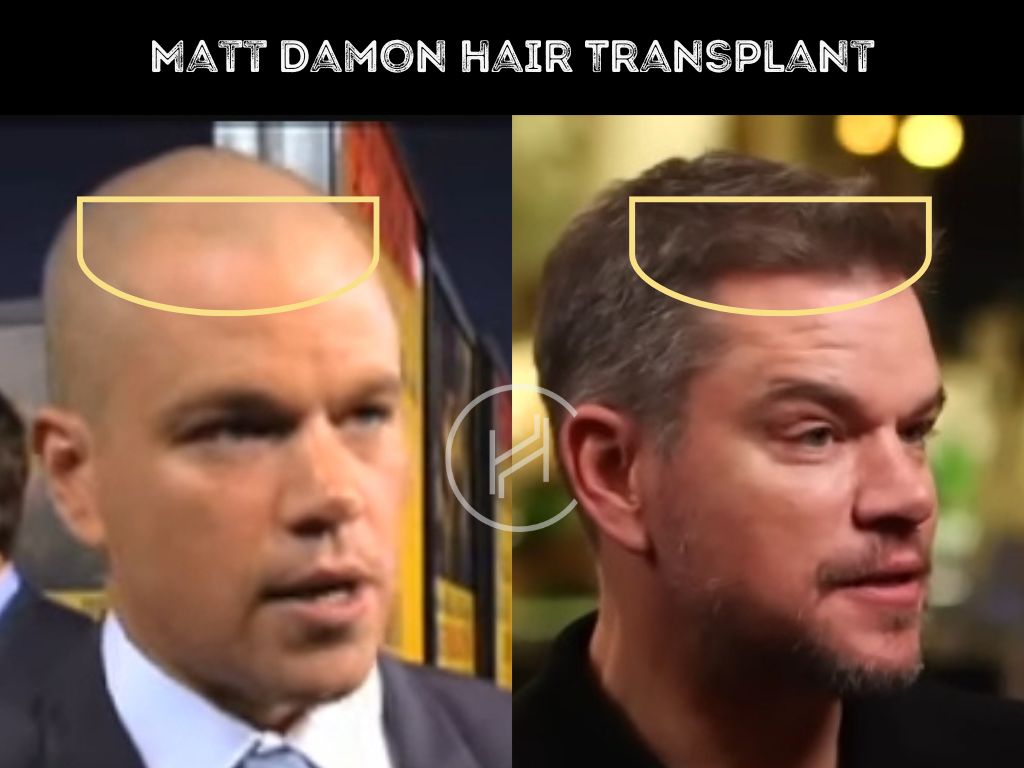 matt damon - hair transplant before and after