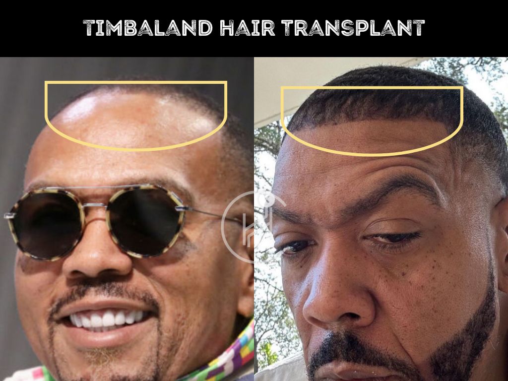 timbaland hair transplant before after result