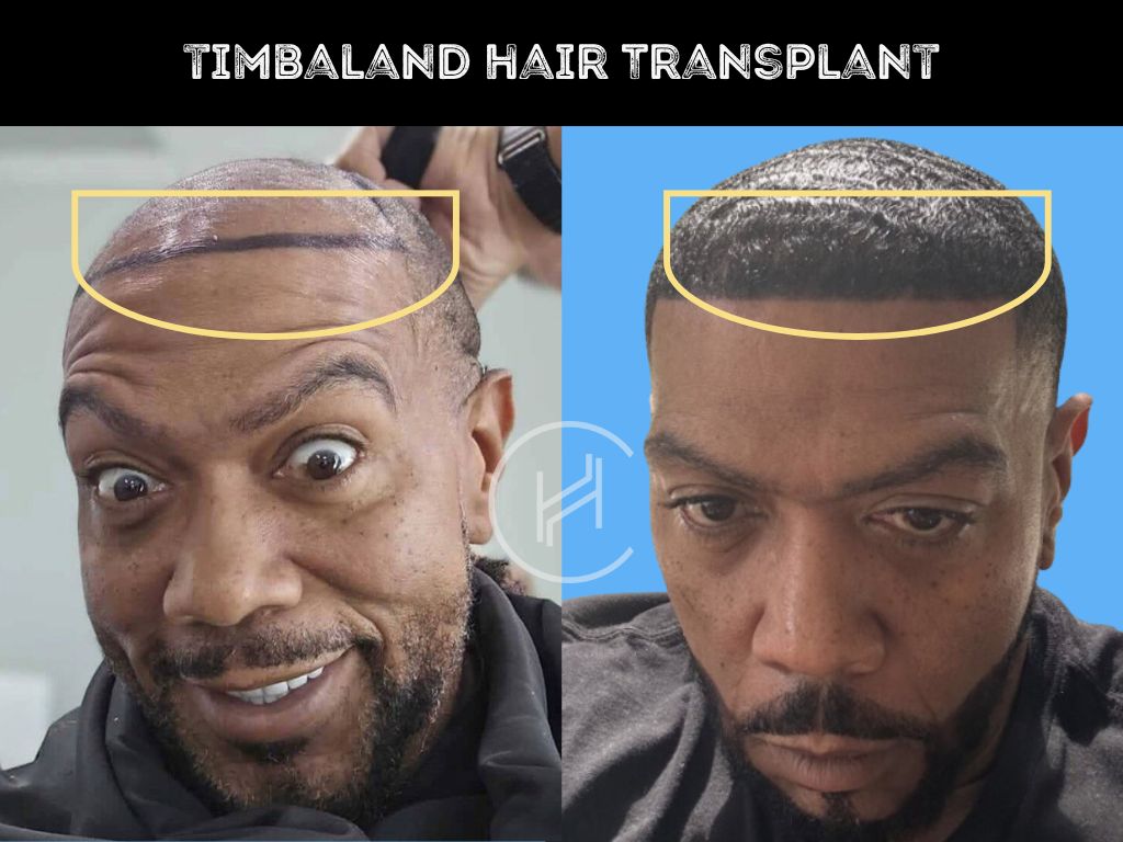 timbaland hair transplant before and after