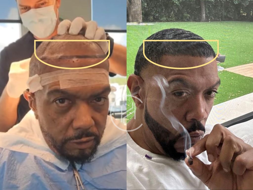 timbaland hair transplant before and after result