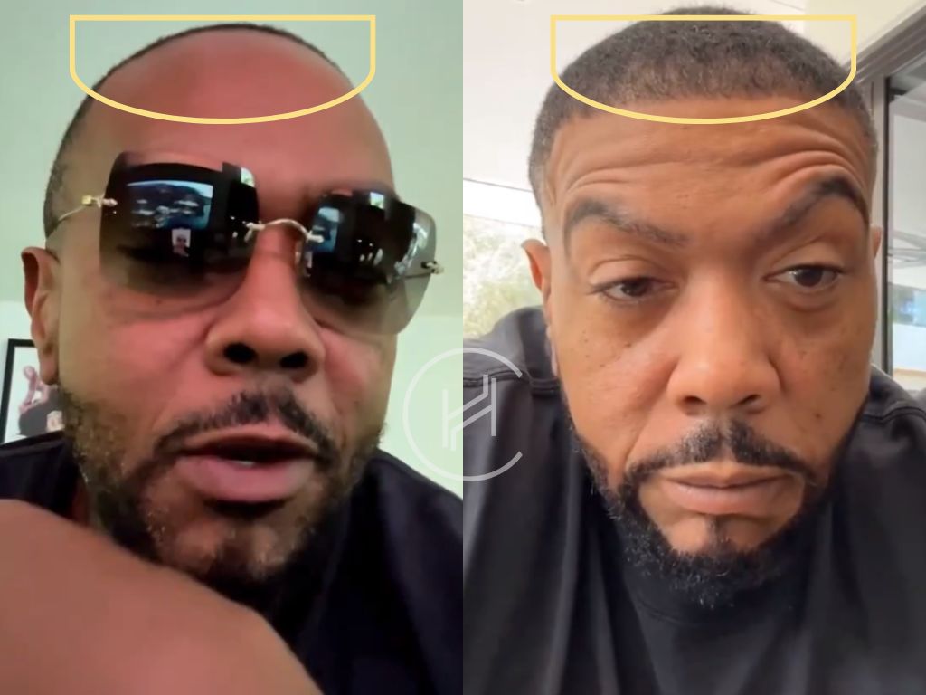 timbaland - hair transplant before and after