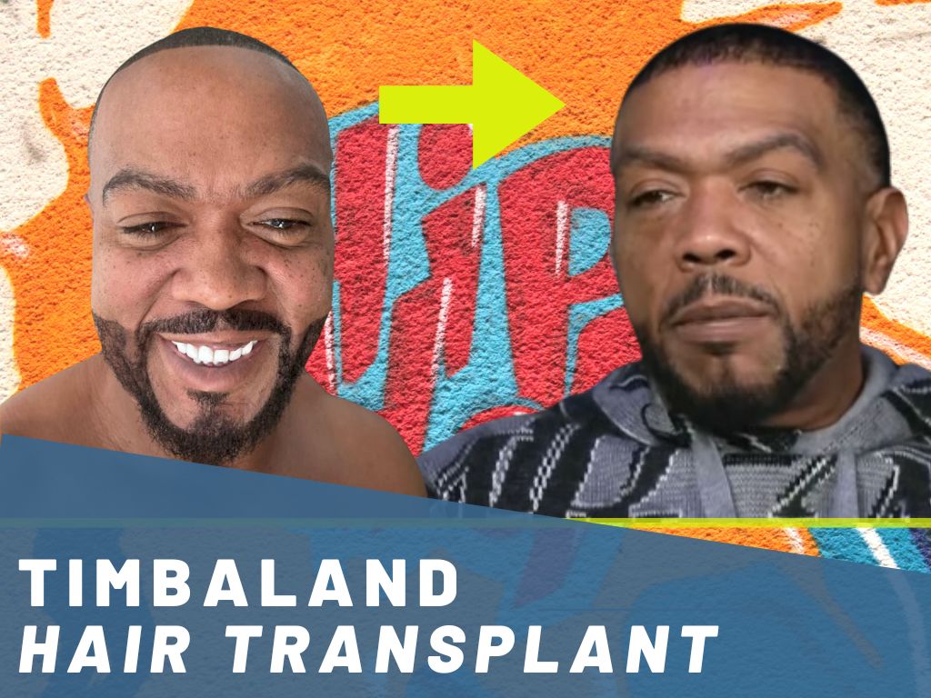 timbaland hair transplant technical analysis