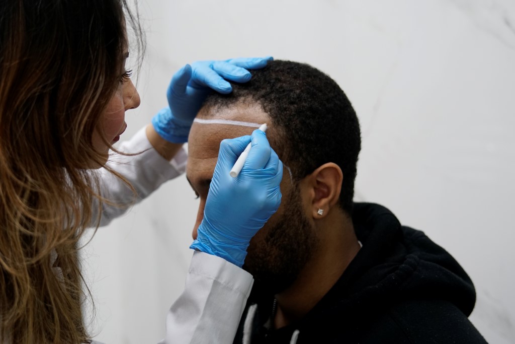 Widow's peak correction hairline before hair transplant