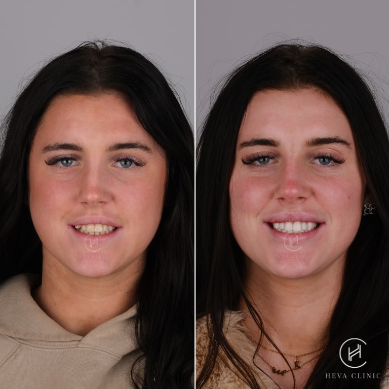 composite bonding before and after result
