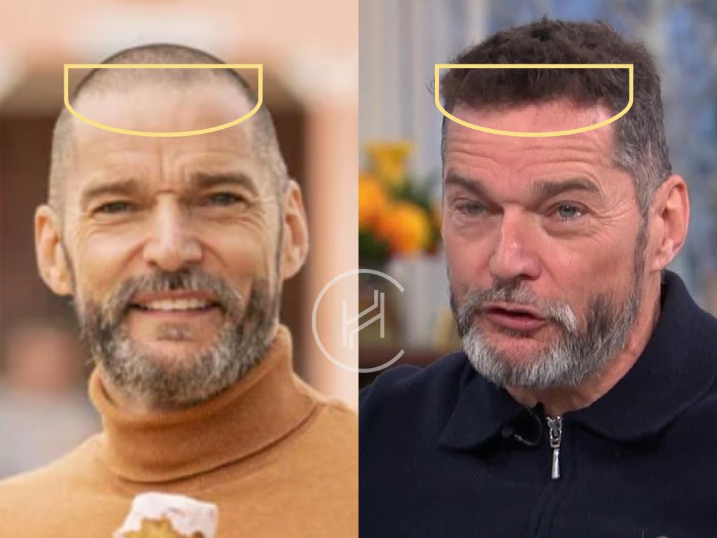 fred sirieix hair transplant before and after