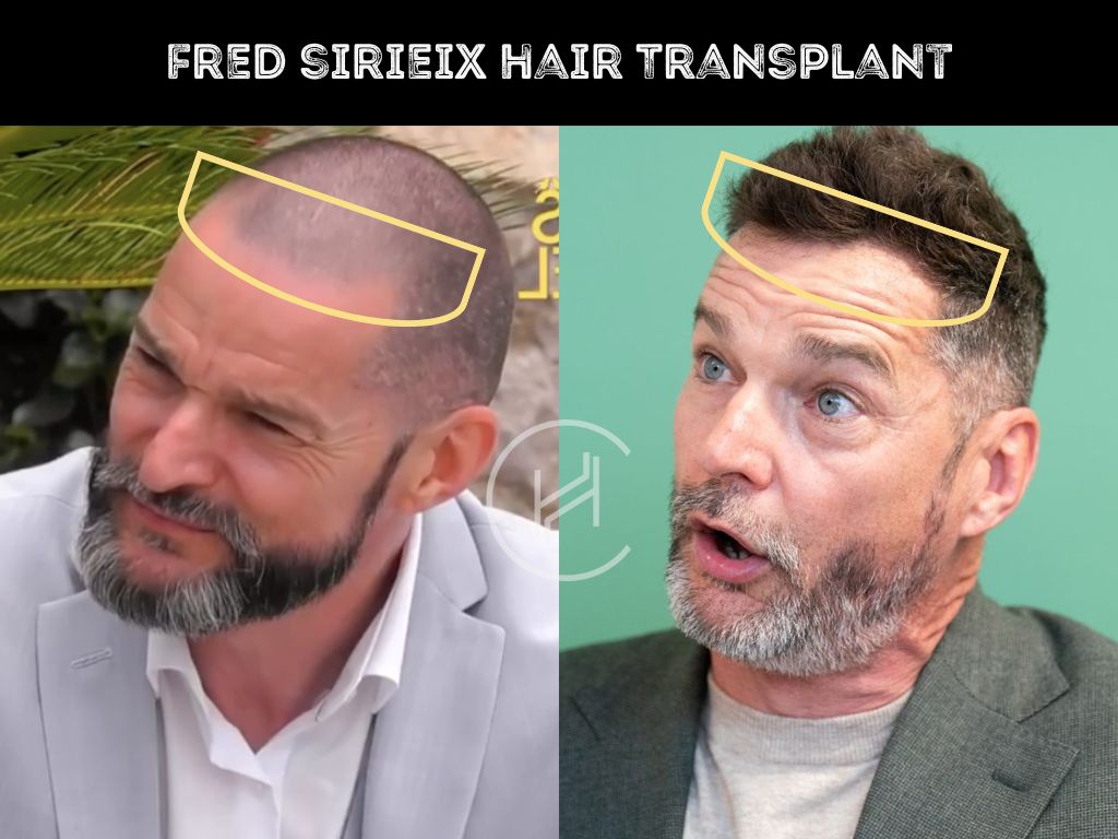 fred sirieix - hair transplant before and after