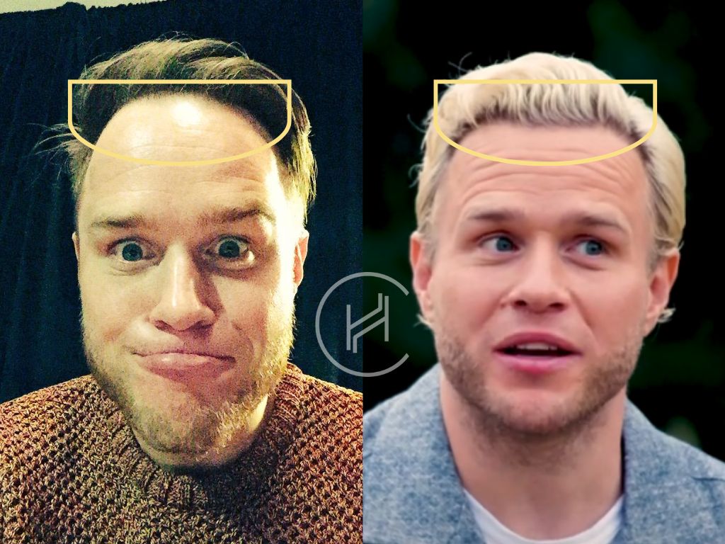 olly murs hair transplant and after