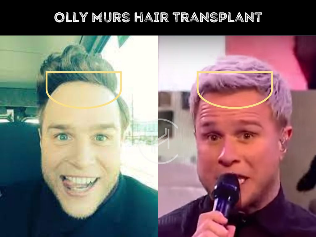 olly murs hair transplant before after result