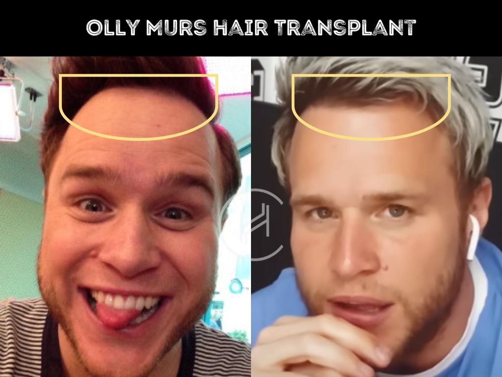 olly murs hair transplant before after result