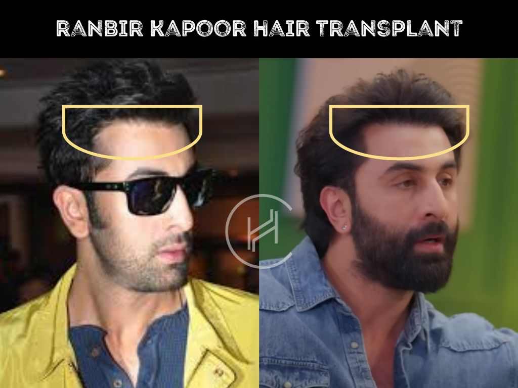 ranbir kapoor hair transplant before and after result