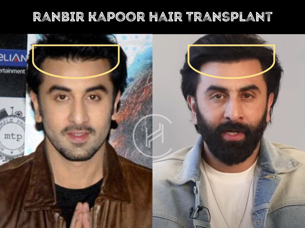 ranbir kapoor - hair transplant before after photo