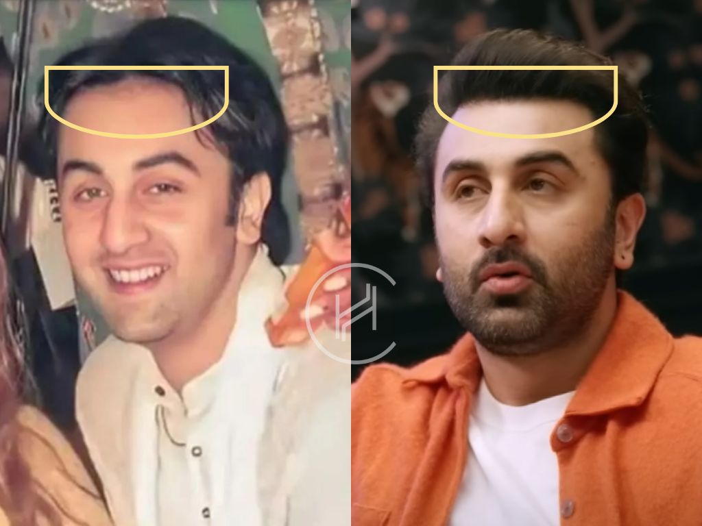 ranbir kapoor - hair transplant before and after photo
