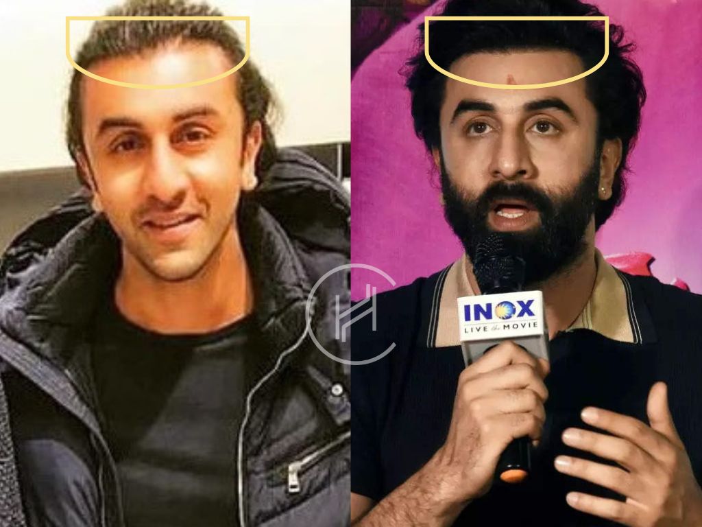 ranbir kapoor hair transplant operation before and after result